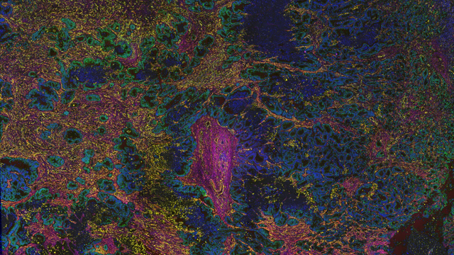 Highly multiplexed microscopy image of a colorectal cancer metastasis. 
The image shows cancer cells and cells attracted to the cancer in yellow, blue, cyan, green and magenta, resulting in a complex but aesthetically pleasing tapestry-like structure.